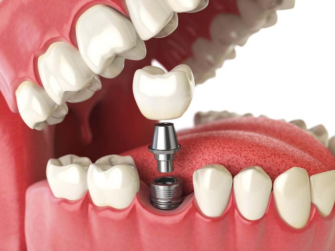 Dental Implants in Dallas, TX Playa Dental